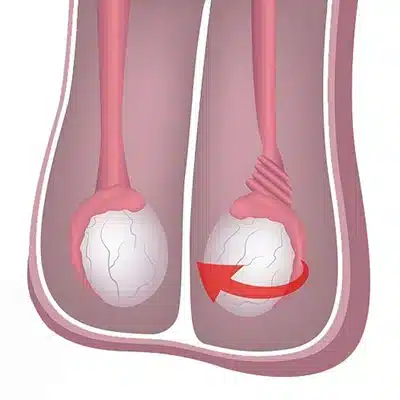 varicocele درمان واریکوسل در طب اسلامی