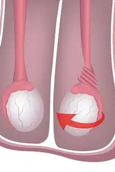 درمان واریکوسل در طب اسلامی